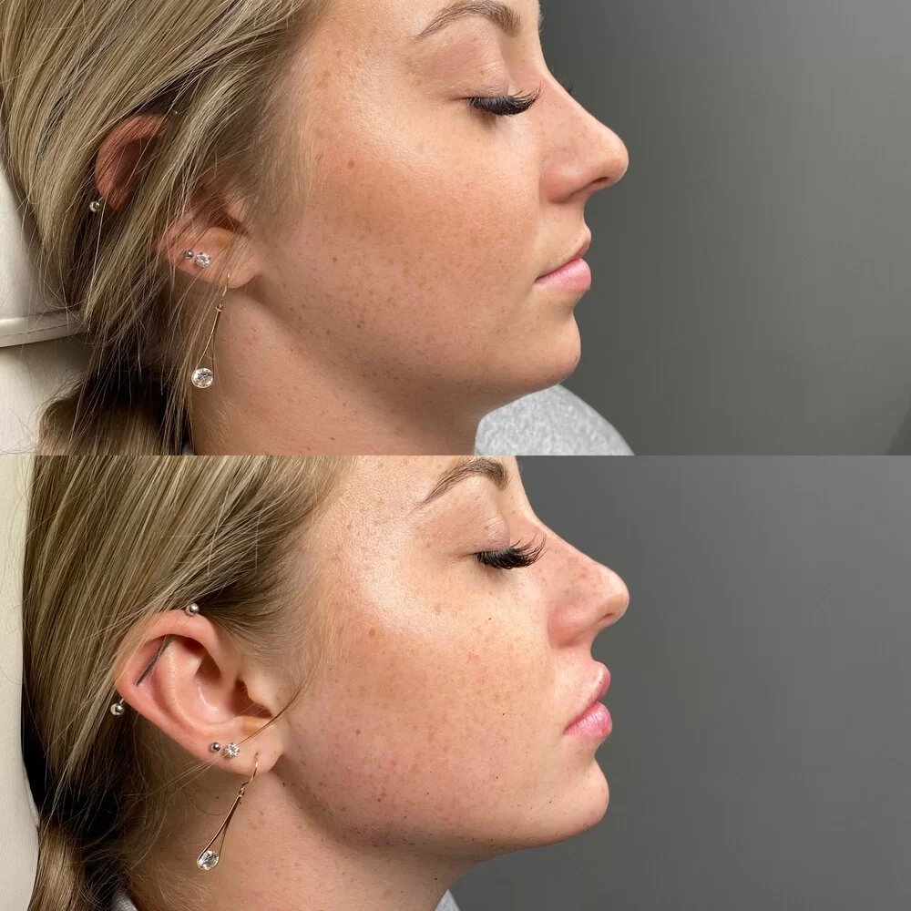 Jawline filler1