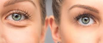 Tear trough fillers