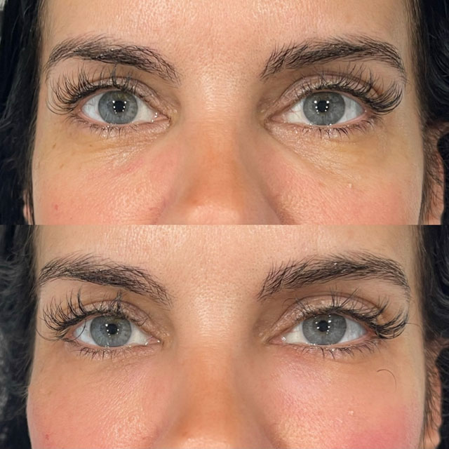 Tear trough fillers1